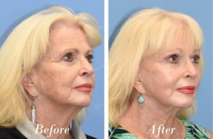 Căng da mặt U70 quay lại U60 - case 29