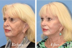 Căng da mặt U70 quay lại U60 - case 29