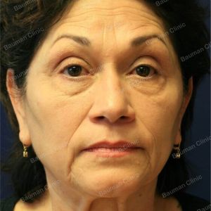 Căng da mặt kết hợp cắt mí trên dưới, nữ 65 tuổi người Mỹ - case 3