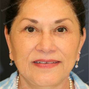 Căng da mặt kết hợp cắt mí trên dưới, nữ 65 tuổi người Mỹ - case 3