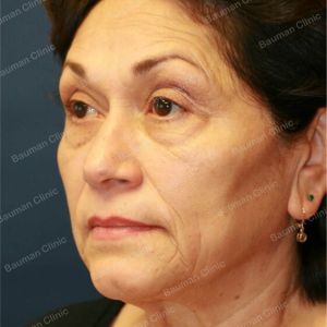 Căng da mặt kết hợp cắt mí trên dưới, nữ 65 tuổi người Mỹ - case 3