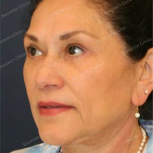 Căng da mặt kết hợp cắt mí trên dưới, nữ 65 tuổi người Mỹ - case 3