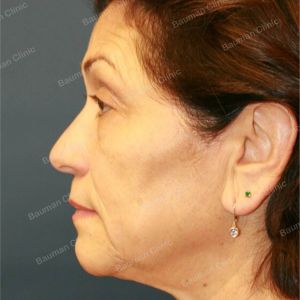 Căng da mặt kết hợp cắt mí trên dưới, nữ 65 tuổi người Mỹ - case 3