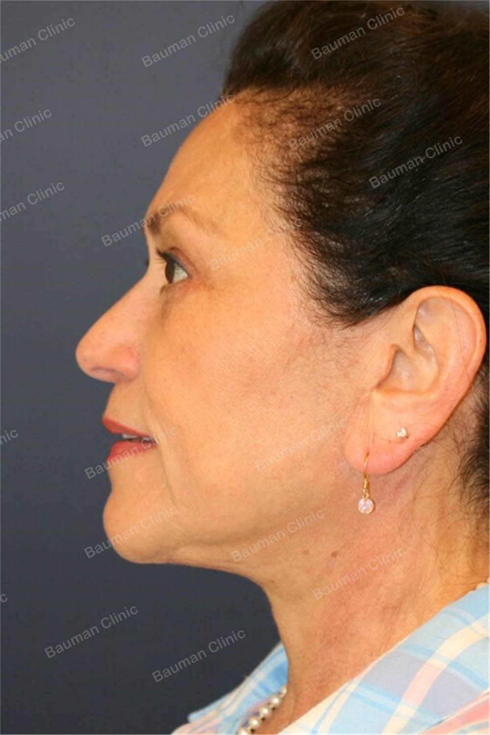 Căng da mặt kết hợp cắt mí trên dưới, nữ 65 tuổi người Mỹ - case 3