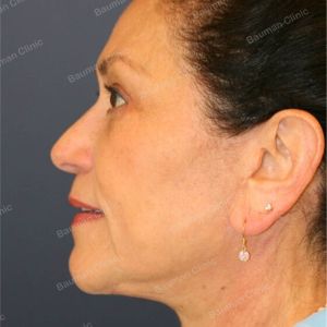 Căng da mặt kết hợp cắt mí trên dưới, nữ 65 tuổi người Mỹ - case 3