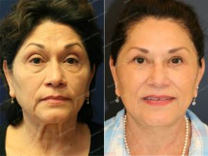 Căng da mặt kết hợp cắt mí trên dưới, nữ 65 tuổi người Mỹ - case 3
