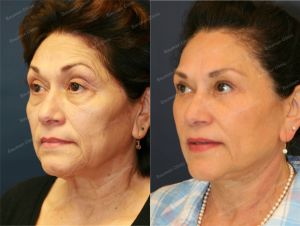 Căng da mặt kết hợp cắt mí trên dưới, nữ 65 tuổi người Mỹ - case 3