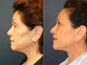 Căng da mặt kết hợp cắt mí trên dưới, nữ 65 tuổi người Mỹ - case 3