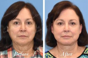 Căng da mặt sau sau 10 tháng - case 31