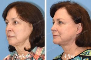 Căng da mặt sau sau 10 tháng - case 31