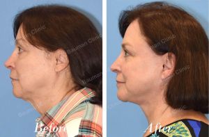 Căng da mặt sau sau 10 tháng - case 31