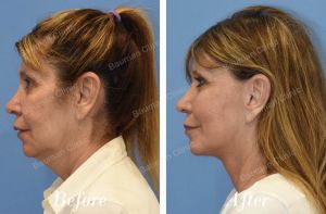 Căng da mặt sau 1 năm - case 37