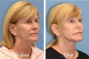 Căng da mặt, khách hàng Mỹ - case 38