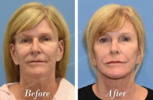 Căng da mặt, khách hàng Mỹ - case 38