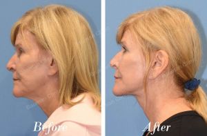 Căng da mặt, khách hàng Mỹ - case 38