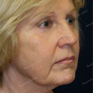 Căng da mặt, nữ 63 tuổi người Mỹ - case 4