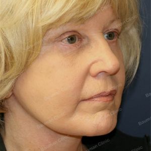 Căng da mặt, nữ 63 tuổi người Mỹ - case 4