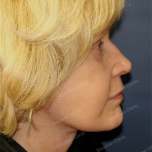 Căng da mặt, nữ 63 tuổi người Mỹ - case 4