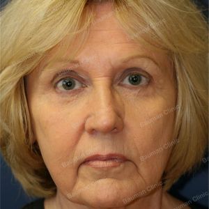 Căng da mặt, nữ 63 tuổi người Mỹ - case 4