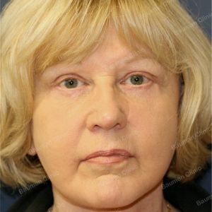 Căng da mặt, nữ 63 tuổi người Mỹ - case 4