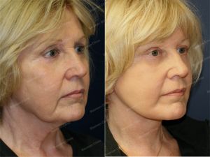 Căng da mặt, nữ 63 tuổi người Mỹ - case 4