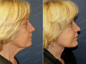 Căng da mặt, nữ 63 tuổi người Mỹ - case 4