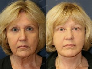 Căng da mặt, nữ 63 tuổi người Mỹ - case 4