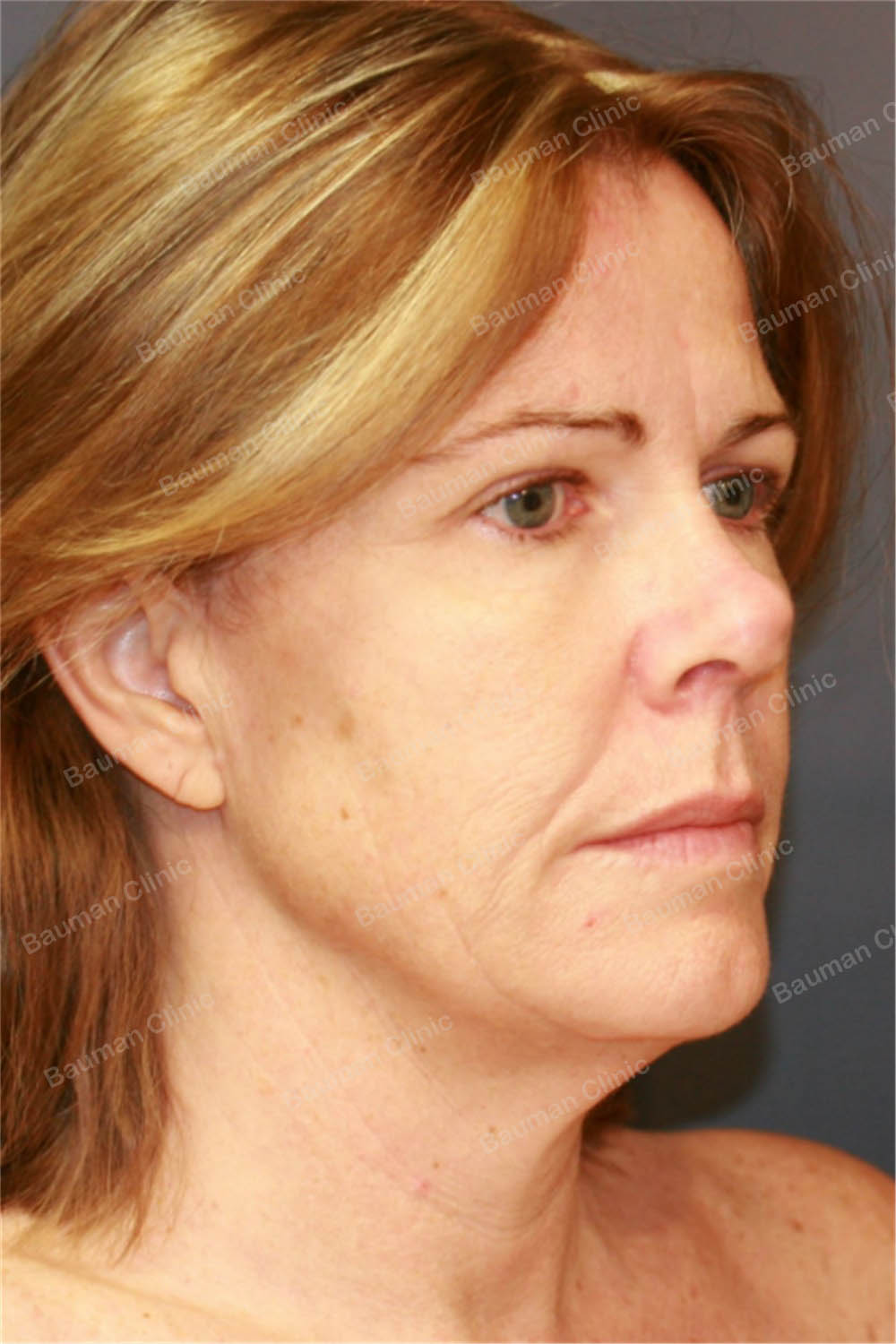 Căng da mặt, nữ 56 tuổi người Mỹ - case 5