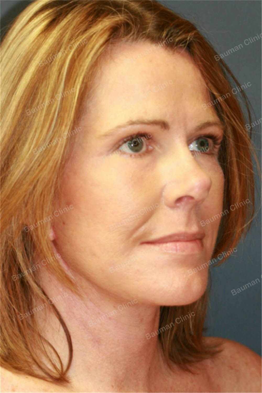 Căng da mặt, nữ 56 tuổi người Mỹ - case 5