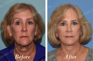 Căng da mặt - case 53