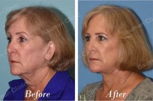 Căng da mặt - case 53