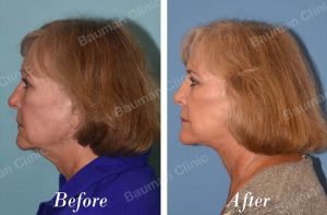 Căng da mặt - case 53