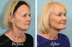 Căng da mặt - case 58