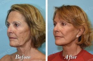 Căng da mặt - case 59