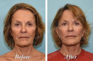 Căng da mặt - case 59