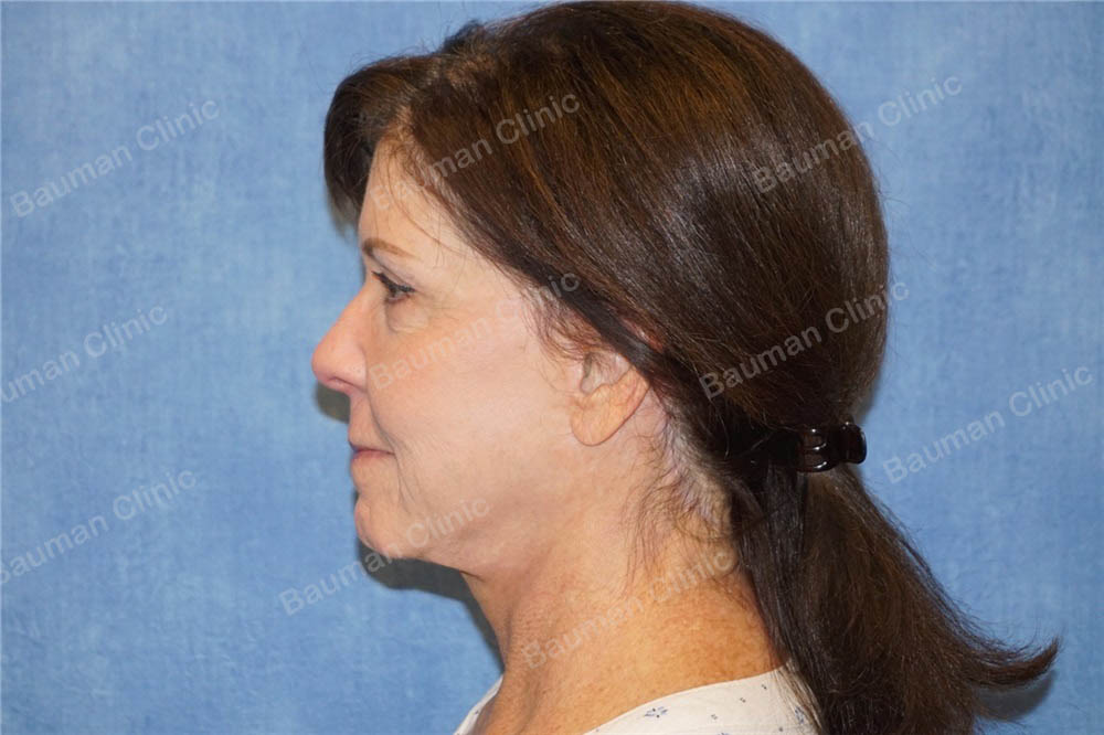 Căng da mặt, nữ 65 tuổi người Mỹ - case 6