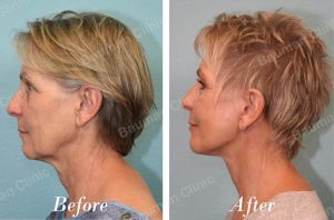 Căng da mặt - case 61