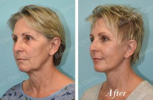 Căng da mặt - case 61