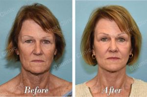 Căng da mặt - case 63