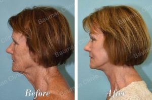 Căng da mặt - case 63