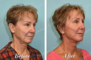 Căng da mặt - case 64