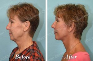 Căng da mặt - case 64