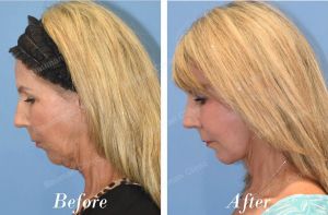 Căng da mặt cổ - case 67