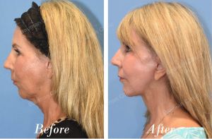 Căng da mặt cổ - case 67