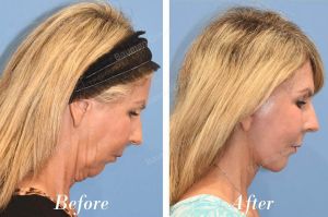 Căng da mặt cổ - case 67