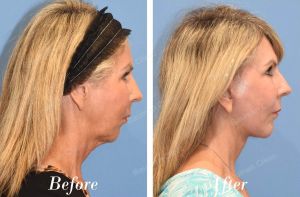 Căng da mặt cổ - case 67