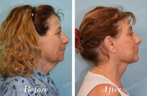 Căng da mặt - case 68