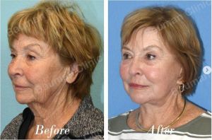 Căng da mặt sau 9 tháng - case 69