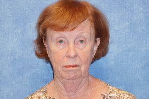 Căng da mặt, khách hàng nữ 69 tuổi Hoa Kỳ - case 7