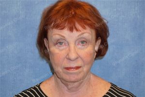 Căng da mặt, khách hàng nữ 69 tuổi Hoa Kỳ - case 7